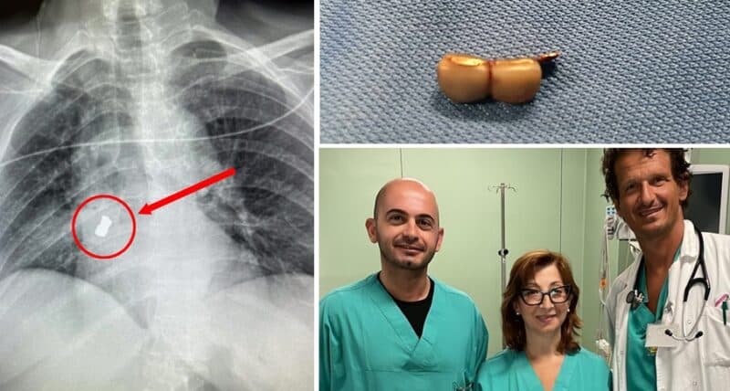 Puglia, donna con febbre e difficoltà a respirare, i medici scoprono un pezzo di dentiera nei polmoni