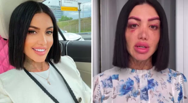 La ricerca della perfezione estetica si è trasformata in un incubo per l'influencer russa Oksana Ovsepyan dopo interventi chirurgici insoddisfacenti.