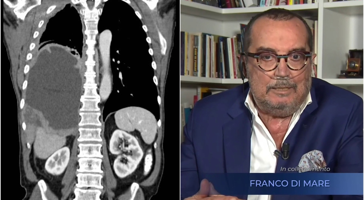 Franco Di Mare rivela in televisione di essere affetto da mesotelioma.